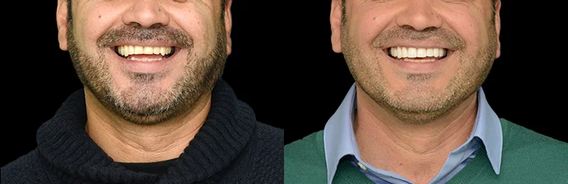 diseño de sonrisa providencia con carillas estéticas digitales