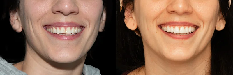 diseño de sonrisa providencia con carillas estéticas digitales
