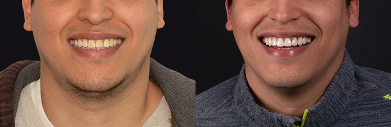 diseño de sonrisa providencia con carillas estéticas digitales