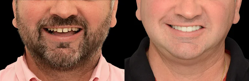 diseño de sonrisa providencia con carillas estéticas digitales
