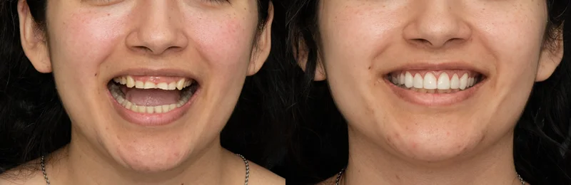 diseño de sonrisa providencia con carillas estéticas digitales