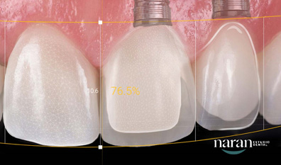 implantes dentales con proceso digital. Clínica Naran