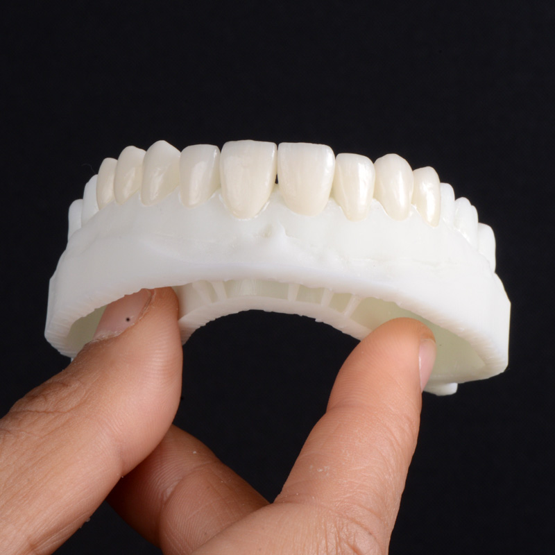 carillas estéticas. Carillas Dentales Procedimiento.