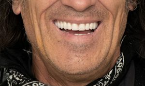 después de implantes dentales