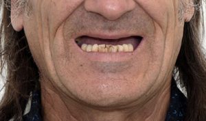 antes de implantes dentales