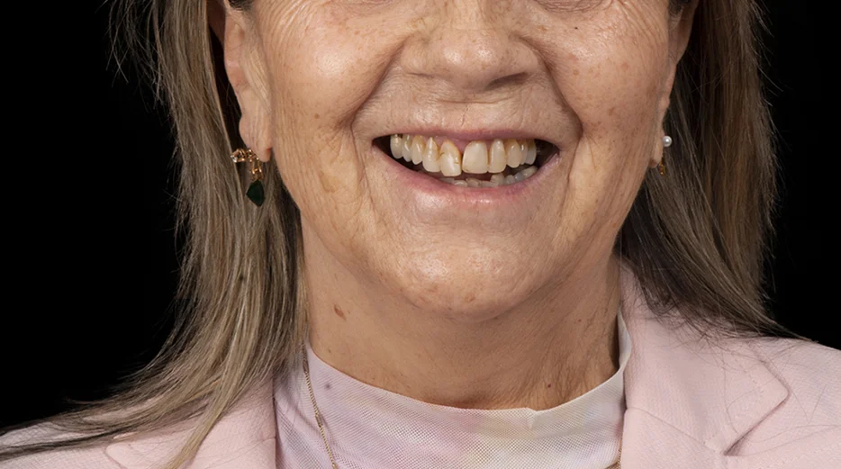 Carillas Dentales Procedimiento Digital. Medición y proporción con ayuda de tecnología. Antes y Después. 2