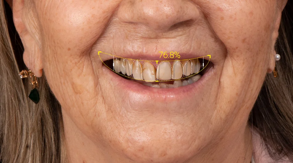 diseño de sonrisa providencia
