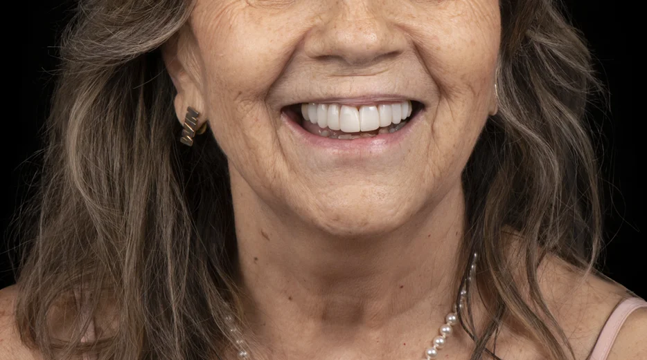 Carillas Dentales Procedimiento Digital. Medición y proporción con ayuda de tecnología. Antes y Después. 3