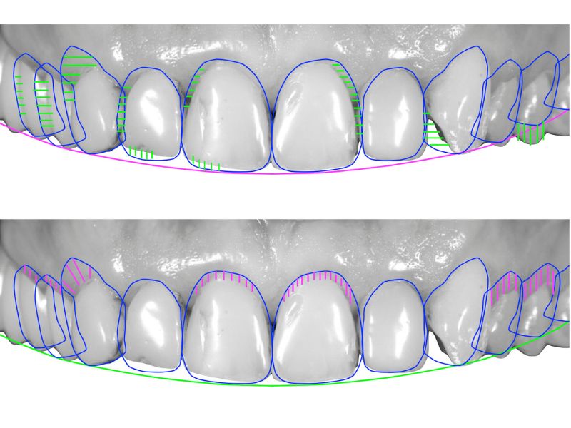 Imagen digitalizada de una dentadura hecha con métodos de odontología digital