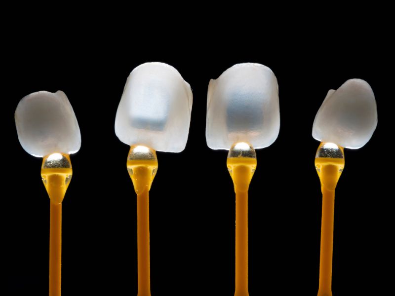 carillas dentales elaboradas por flujo digital