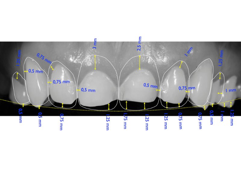 Imagen digital de una dentadura con detalles de dimensiones para la elaboración de carillas dentales con flujo digital