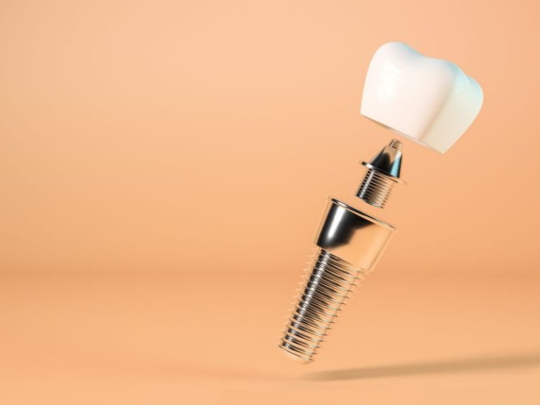 implante dental