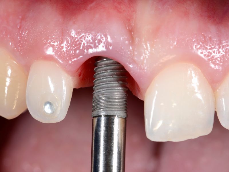 colocación de implante dental