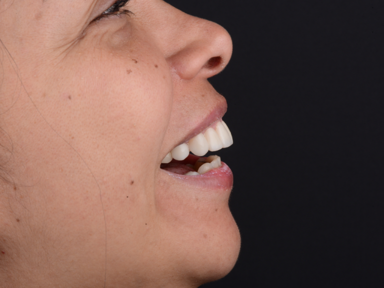 Perfil de una mujer sonriendo con carillas dentales