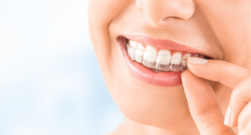 mujer sonriendo con ortodoncia invisible puesta