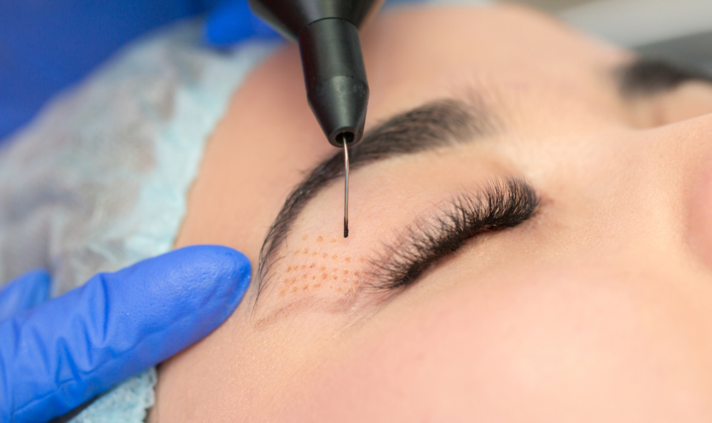 mujer que está en tratamiento de estética facial con una pluma de plasma en el párpado