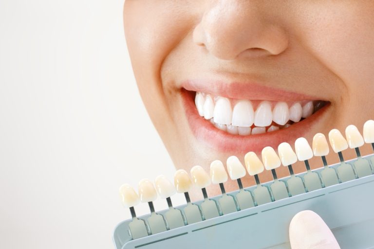 Sonrisa a una joven junto a un blanqueamiento de dientes cosmetológico