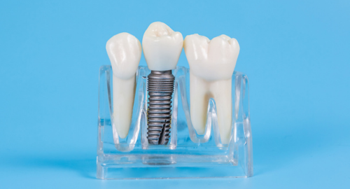 modelos de implantes dentales