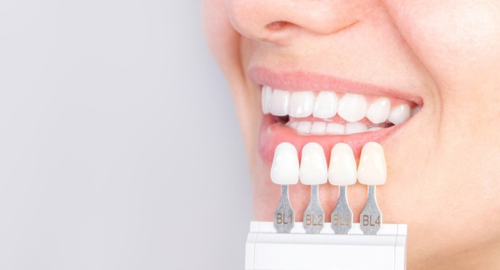modelo de carilla dental