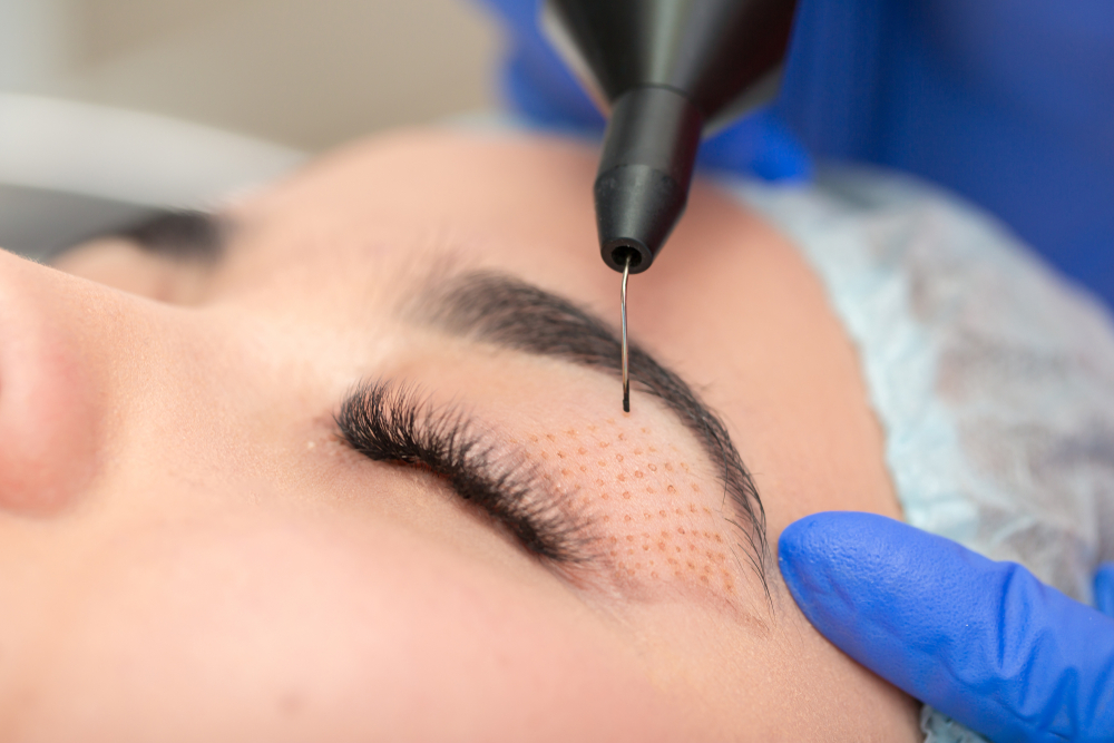 blefaroplastia no quirúrgica con plasmage