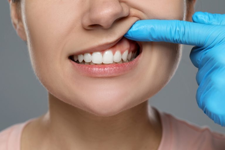 mujer mostrando sus encías después de plástica periodontal