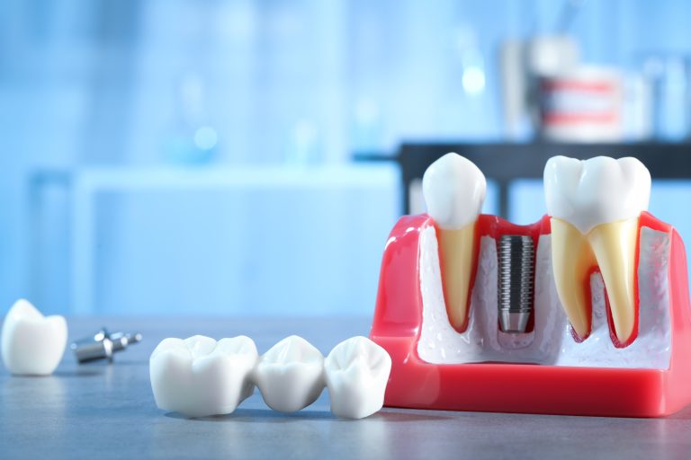 Maqueta que muestra cómo funciona el Implantes de dientes con figura de dientes alrededor y vista a un laboratorio odontológico al fondo