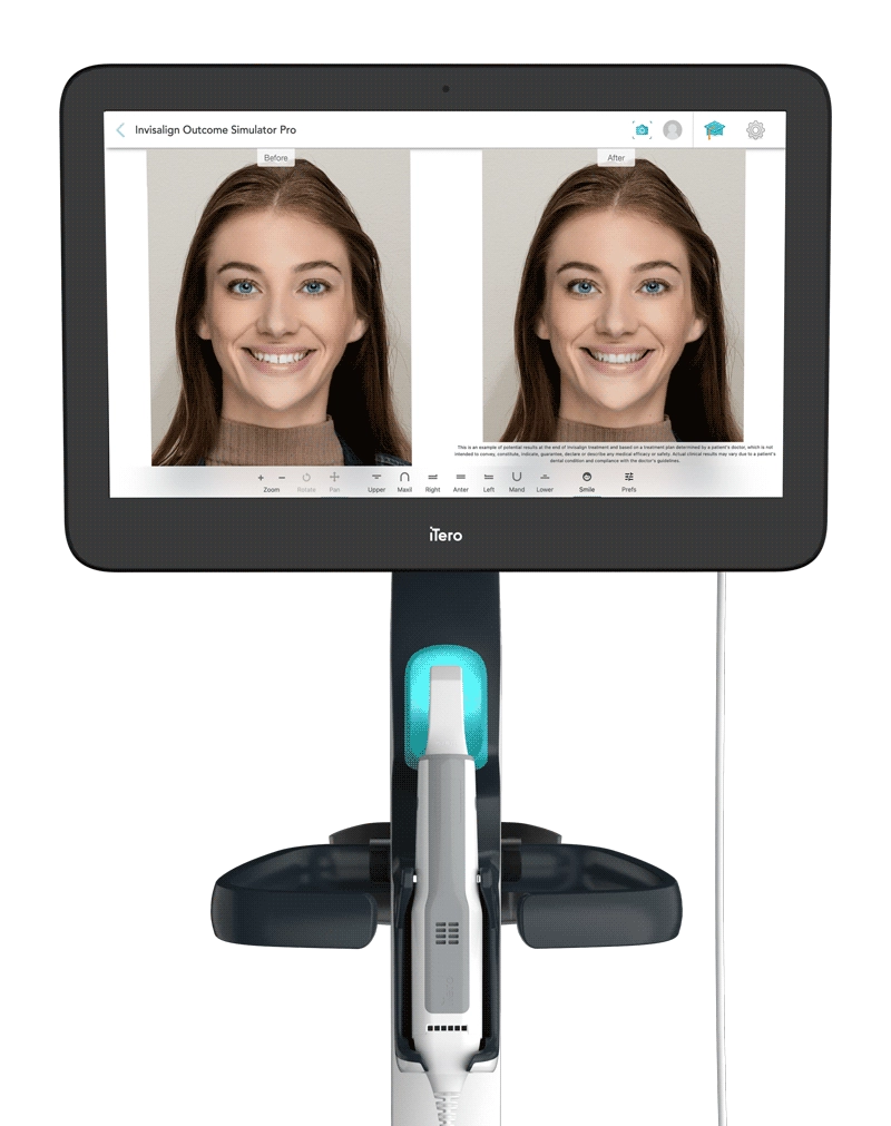 Invisalign es un tratamiento innovador que utiliza la tecnología Itero para sus tratamientos en ortodoncia invisible. En naran somos expertos en ortodoncia invisible