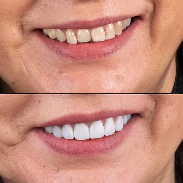 Invisalign alineadores con carillas dentales
